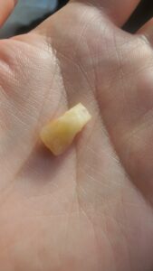 歯医者「歯が埋めってるんで歯ぐき切って開きますね＾＾」前歯の抜歯を語る回。