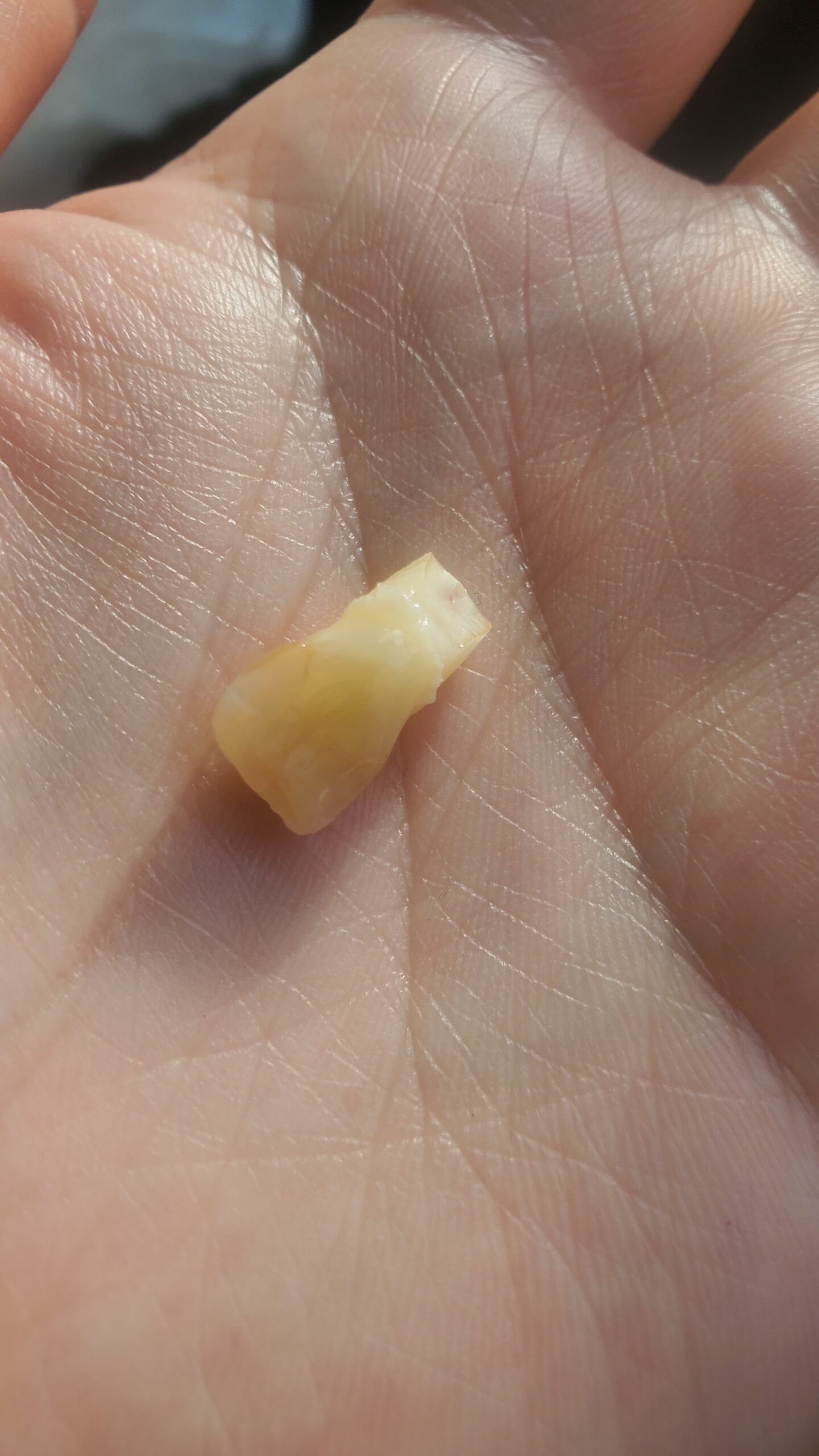 歯医者「歯が埋めってるんで歯ぐき切って開きますね^^」前歯の抜歯を語る回。