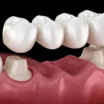 歯医者「根こそぎ折れてて差し歯は不可ですね」