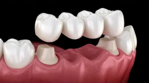 歯医者「根こそぎ折れてて差し歯は不可ですね」