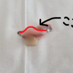 【ついに！】1本18万円の入れ歯を装着する。前歯1本ミラクルデンチャー初日の使用感を語る