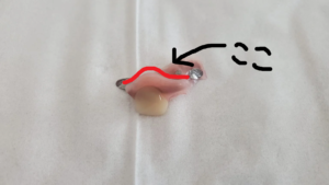 【ついに！】1本18万円の入れ歯を装着する。前歯1本ミラクルデンチャー初日の使用感を語る