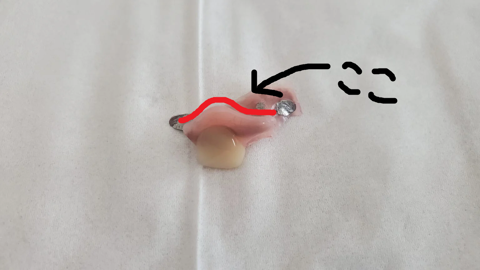 【ついに!】1本18万円の入れ歯を装着する。前歯1本ミラクルデンチャー初日の使用感を語る